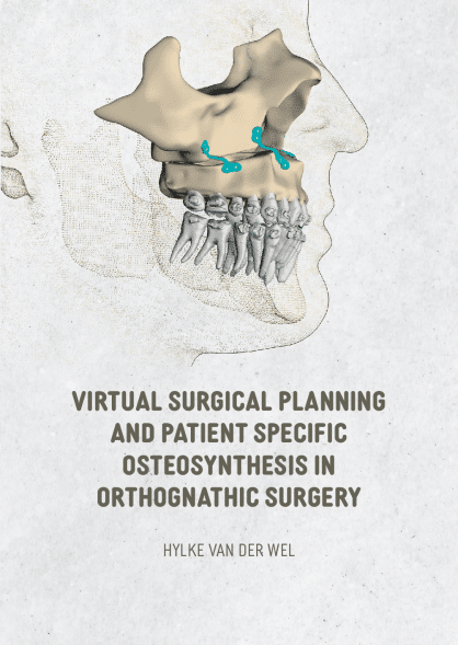 Virtual Surgical Planning in patient-specific osteosynthesis